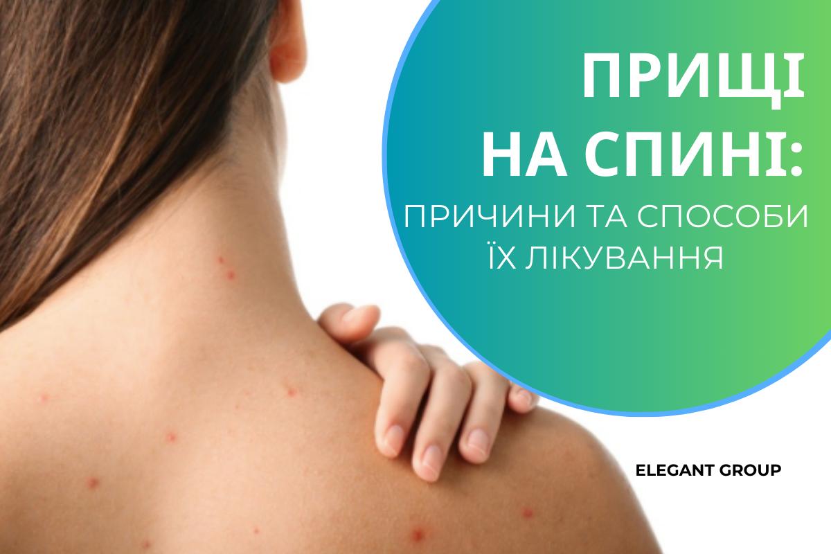 Прищі на спині: причини та способи їх лікування