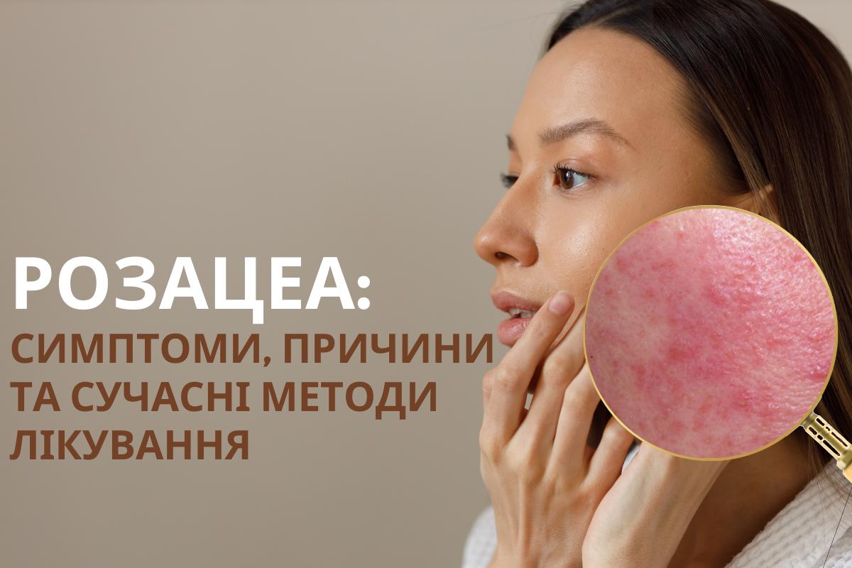 Розацеа: симптоми, причини та сучасні методи лікування