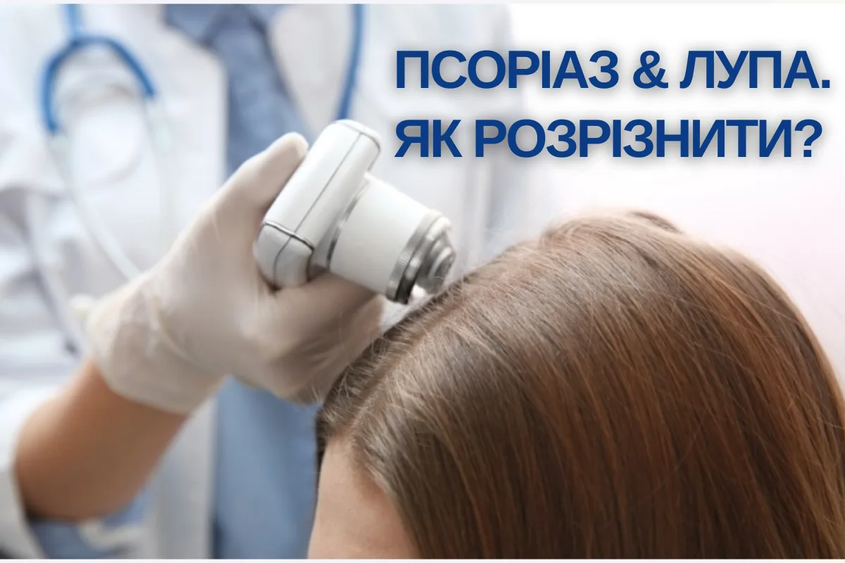 Psoriasis & Dandruff. How to Distinguish?